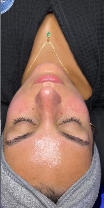 Teint nach der AquaFacial-Behandlung bei Beauty by Gashi